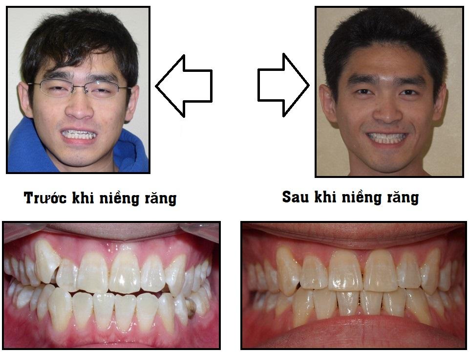 Niềng răng mắc cài sứ giúp bạn tự tin hơn trong giao tiếp vì không bị quá chú ý như mắc cài kim loại