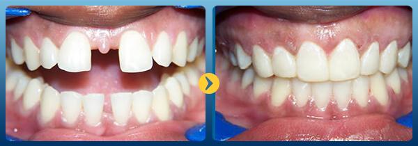 Cầu răng sứ được xem là phương pháp phục hình răng vô cùng tiết kiệm