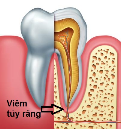 Sâu răng dẫn đến viêm tủy răng