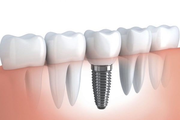 Làm răng implant cho người già?
