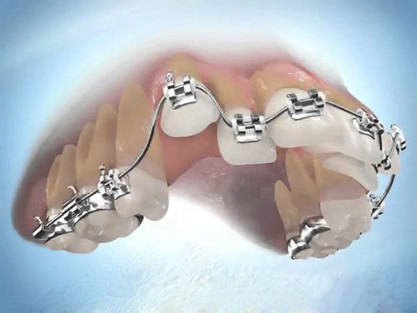 Răng mọc ngược vào phía trong có thể khắc phục bằng phương pháp chỉnh nha