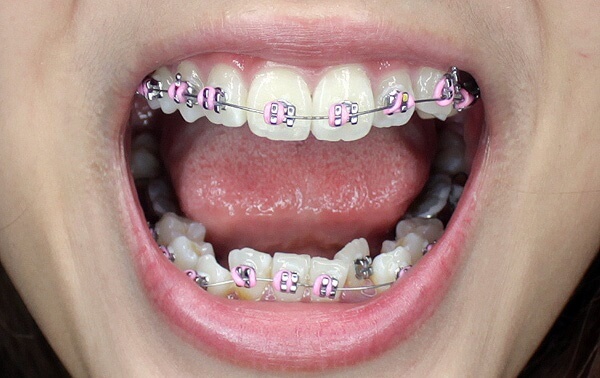 Thời gian đeo niềng răng phụ thuộc vào tình trạng của mỗi người