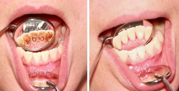 Răng bị đen bên trong sau khi được điều trị