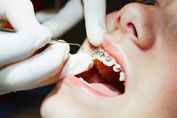 Niềng răng giúp khắc phục tình trạng răng quặp vào trong hiệu quả