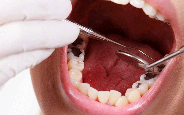Sâu răng khiến xuất hiện những chấm màu đen trên răng