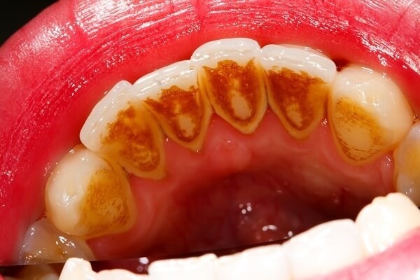 Răng bị đen bên trong do răng miệng không đúng cách