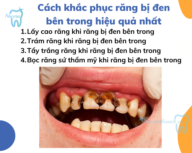 Những phương pháp khắc phục răng bị đen bên trong hiệu quả