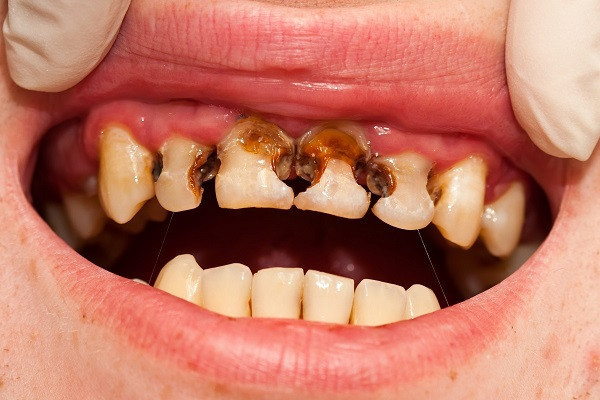 Răng bị đen bên trong do bệnh lý sâu răng