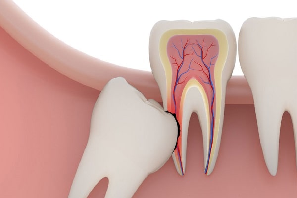 Nhổ răng số 8 có ảnh hưởng và nguy hiểm không?