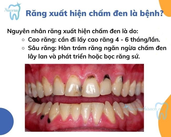 Răng bị chấm đen là dấu hiệu của bệnh gì và cách xử lý ra sao?