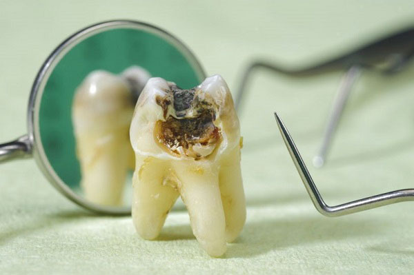 Sâu răng là nguyên nhân phổ biến gây đau răng ở bà bầu