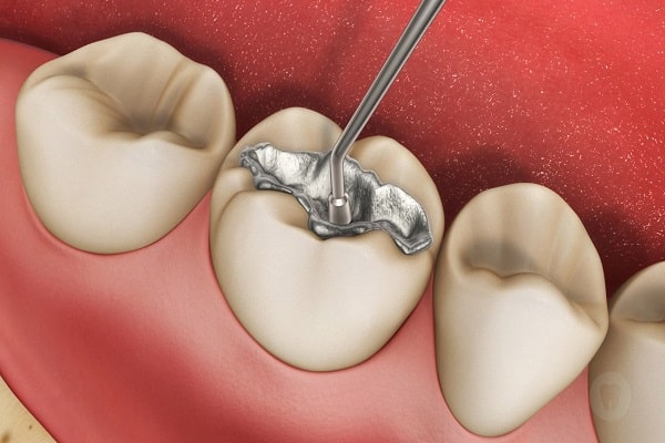 Sau khi lấy tủy răng, bác sĩ sẽ hàn trám răng để bít lại lỗ tủy