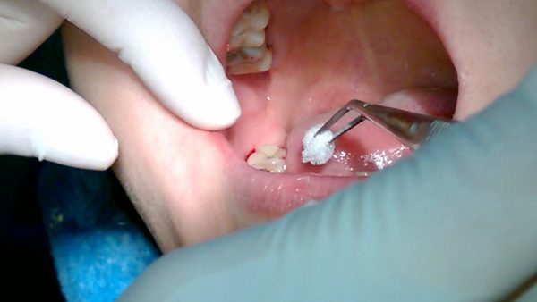 Áp xe răng số 8 các bác sĩ sẽ khuyên bạn nên nhổ sớm