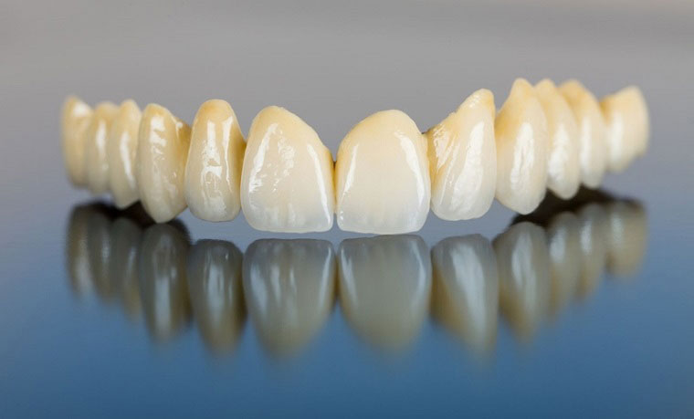 Răng sứ kim loại có mức giá rẻ hơn các dòng răng toàn sứ