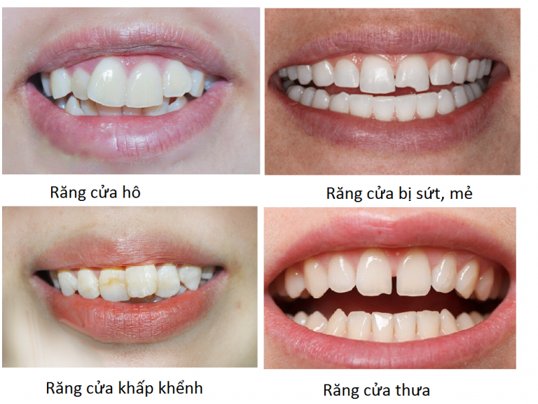 Một số trường hợp có thể bọc răng sứ cho răng cửa
