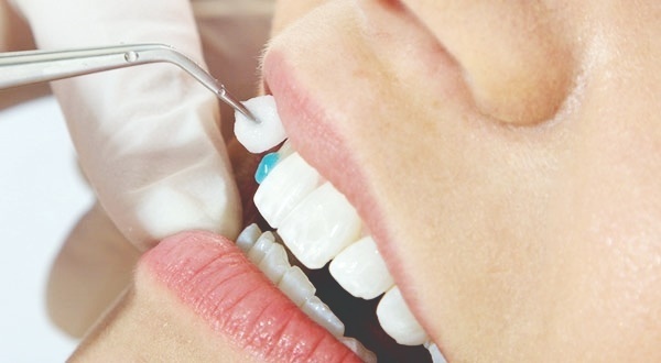 Thời gian dán sứ Veneer trung bình từ 10 – 15 phút/răng
