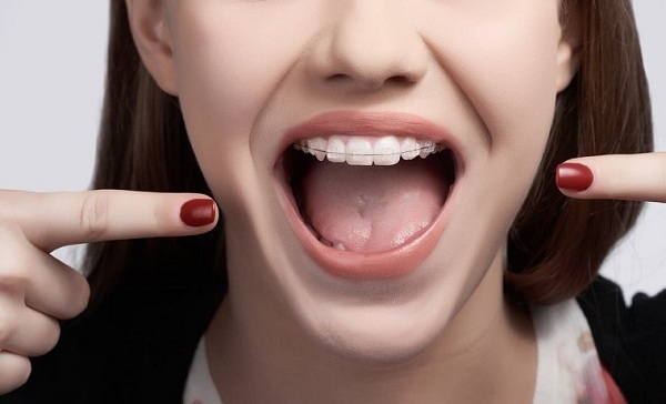 Giá niềng răng trên thị trường dao động từ 20 triệu – 180 triệu