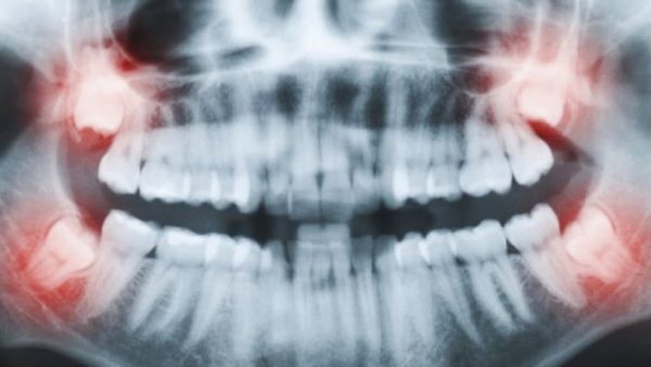 Các bác sĩ khuyên bạn không nên nhổ 4 răng khôn một lúc tránh ảnh hưởng đến quá trình ăn nhai