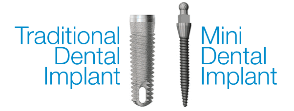 Mini Implant có kích thước nhỏ gọn hơn Implant thông thường