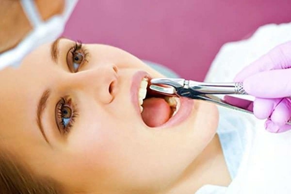 Nhổ răng khểnh nhanh gọn chỉ trong 15 phút nếu đúng phương pháp