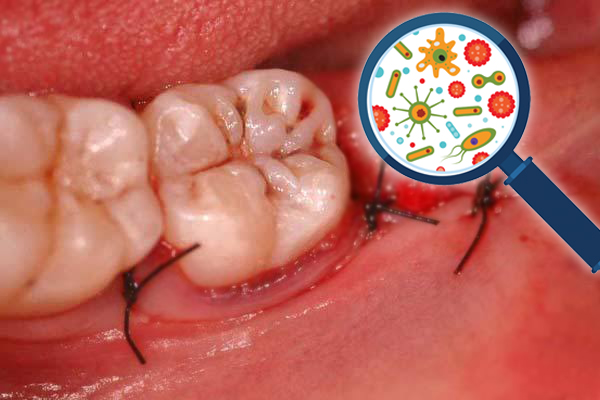 Nhổ răng khôn không cẩn thận là nguồn cơn của vi khuẩn gây hôi miệng