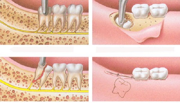 Nhổ răng khôn cũng giống như các ca tiểu phẫu khác thì chảy máu là điều bình thường