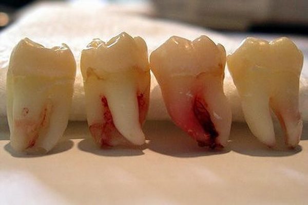 Răng khôn có rất nhiều hình dạng và cách mọc cũng rất khác thường