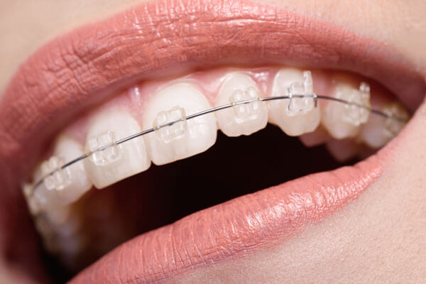 Niềng răng thẩm mỹ là giải pháp cải thiện hàm răng lệch lạc, tỷ lệ xấu