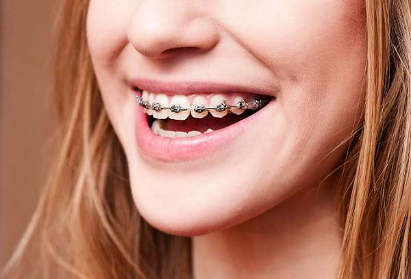 Niềng răng giúp khắc phục răng thưa hiệu quả