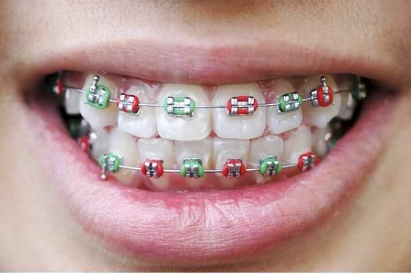 Niềng răng giúp răng thẳng hàng và đều hơn