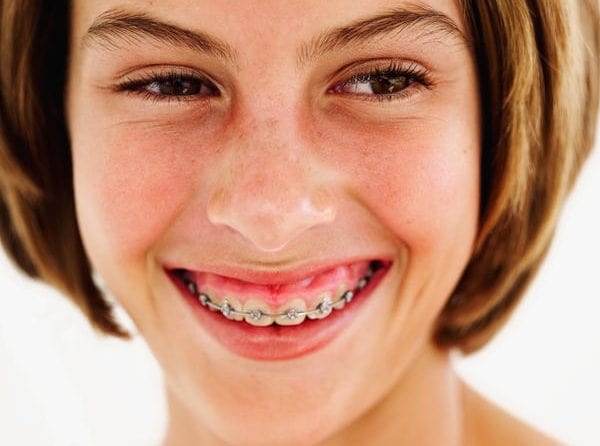 Có một số ít trường hợp niềng răng xong cười hở lợi