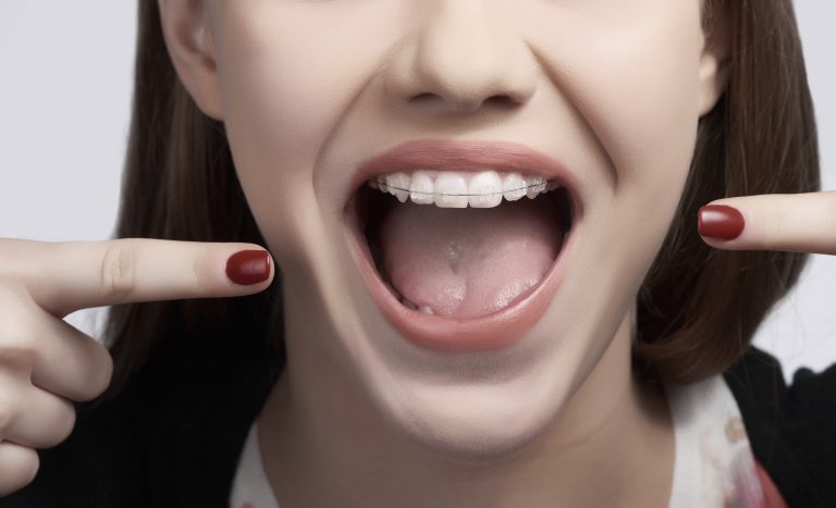 Chi phí niềng răng cửa từ 25 – 120 triệu đồng tùy từng loại