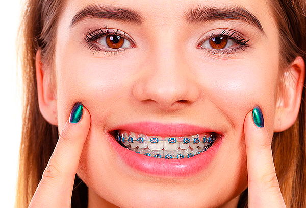 Niềng răng có thể khắc phục được “khuyết điểm” bị hở lợi khi cười