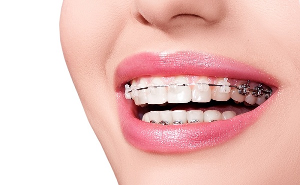 Niềng răng giúp bạn sở hữu nụ cười đẹp hơn
