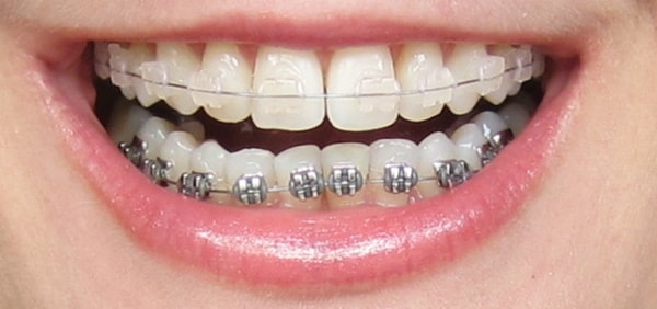 Nhiều người niềng răng thẩm mỹ với mong muốn sở hữu nụ cười đẹp hơn