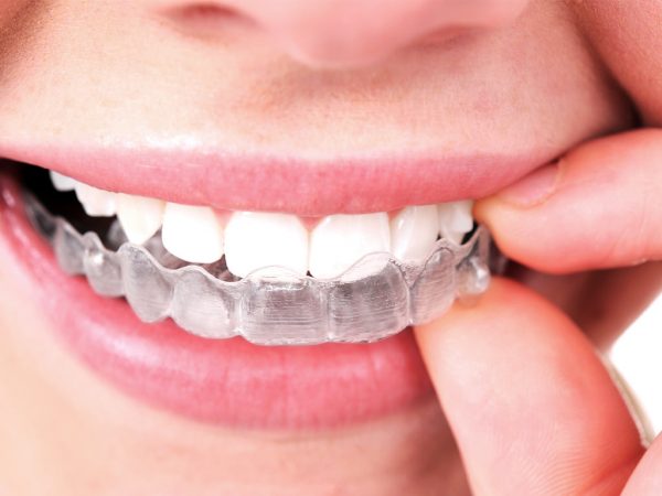 Niềng răng trong suốt Invisalign bệnh nhân dễ dàng tháo lắp để vệ sinh và ăn uống