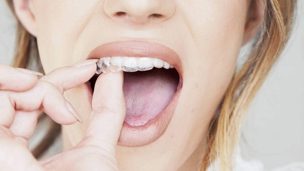 Niềng răng không mắc – Phương pháp chỉnh nha chi phí cao nhất hiện nay