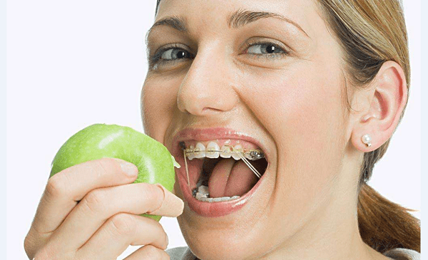 Khi niềng răng nên tránh ăn các đồ ăn cứng