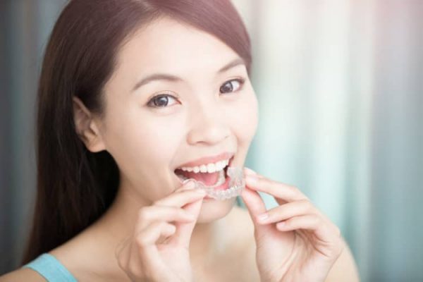 Người dùng niềng răng trong suốt có thể tự tháo lắp khi ăn nhai hay vệ sinh răng