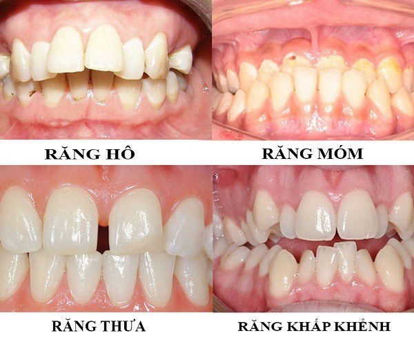 Niềng răng khắc phục “khuyết điểm” của hàm răng khiến bạn luôn cảm thấy tự ti
