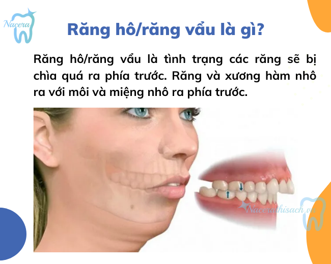 Răng hô/răng vẩu là gì?