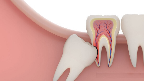 Răng khôn hàm dưới ở vị trí nhạy cảm và khó tiếp cận gây khó khăn cho các bác sĩ