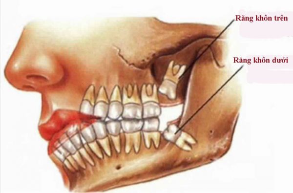Răng khôn hàm dưới thường xuất hiện nhiều biến chứng hơn răng khôn hàm trên