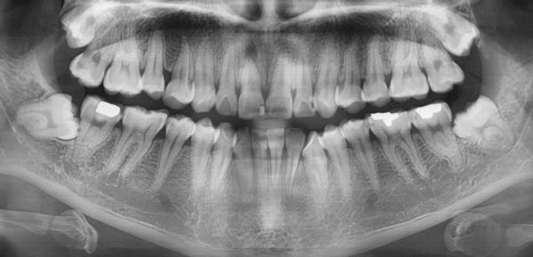 Có thể phát hiện răng khôn mọc ngầm, mọc ngang bằng phim X-quang