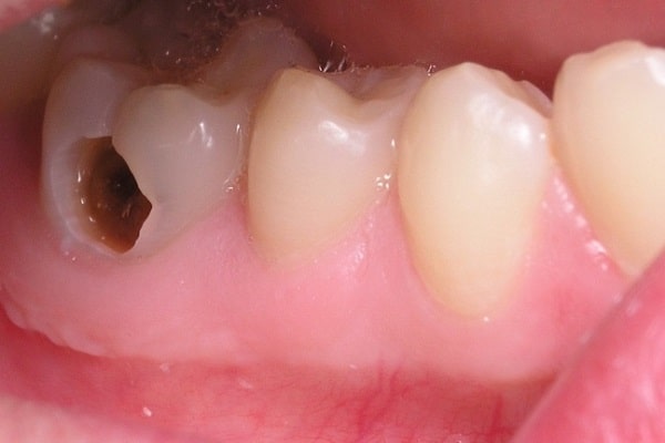 Viêm tủy răng cấp nguyên nhân chính do sâu răng biến chứng thành