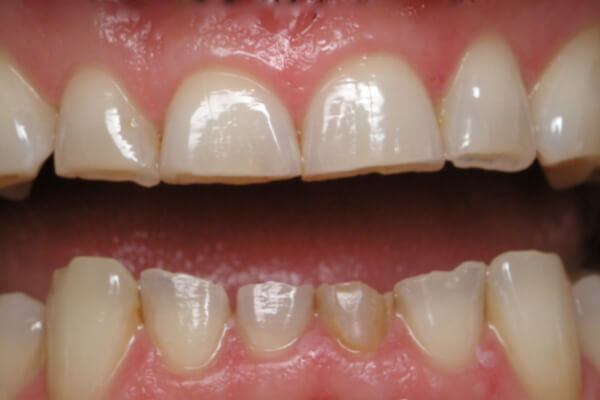 Răng sứ bị mòn mặt nhai khi nhìn vào sẽ thấy bằng phẳng hơn bình thường