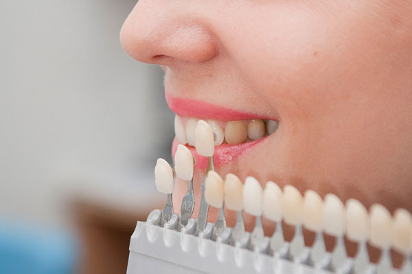 Răng sứ Emax có mức giá khá cao, khoảng 8.000.000 đồng/răng