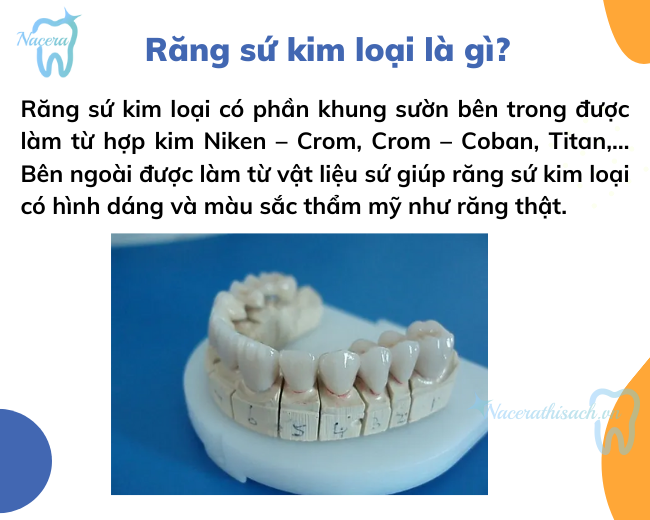Răng sứ kim loại là gì?