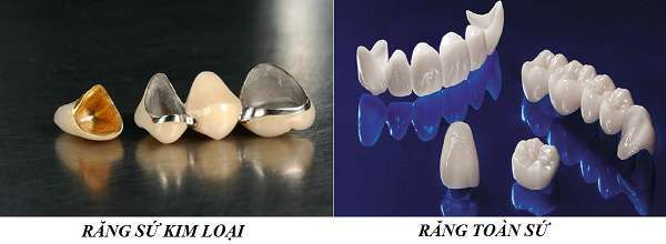 Răng sứ kim loại và răng toàn sứ đều có thế mạnh – hạn chế riêng