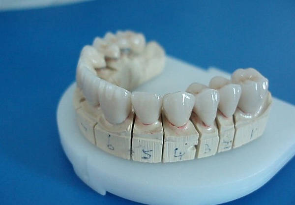 Bạn có thể lựa chọn răng sứ Titan để tiết kiệm chi phí